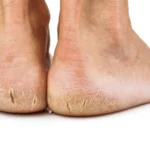 Causas de los talones agrietados